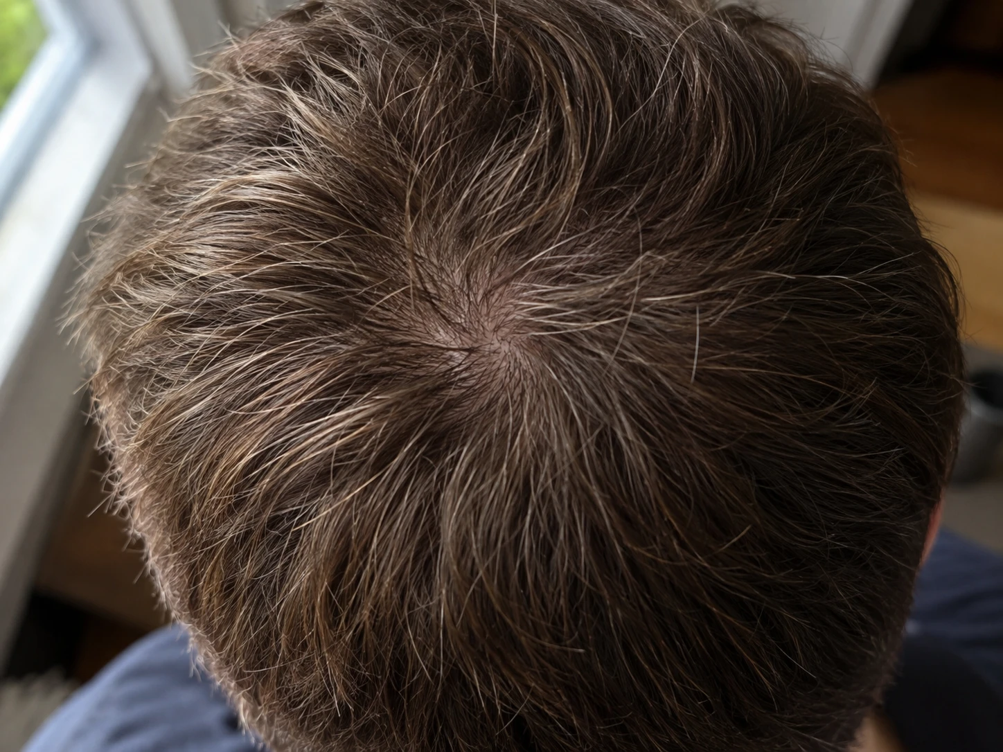 Overhead view of the natural hair whorl at the crown