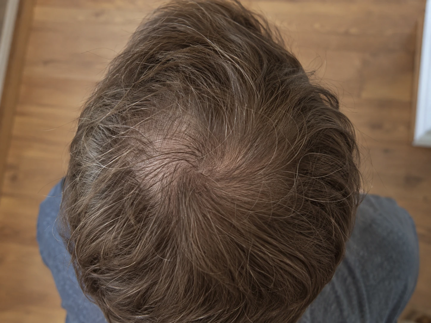 Overhead view of fine brown hair and visible scalp around the crown